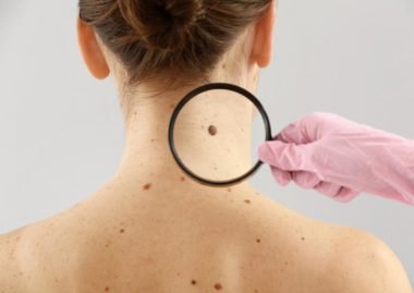Melanoma